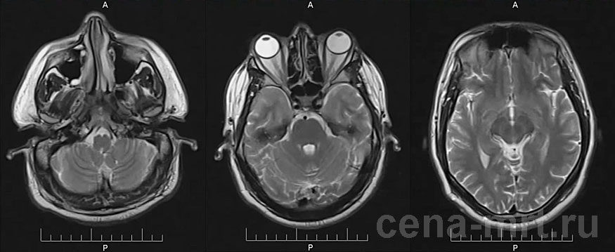 Норма мозга. Мрт головного мозга аксиальный срез. Мрт головного мозга аксиальная проекция. Мрт головного мозга норма сверху. Мрт срезы головного мозга норма.